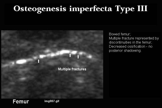 Osteogenesis imperfecta ii