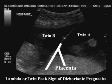 Twin Peak Sign (Lambda sign) = Dichorionic Pregnancy