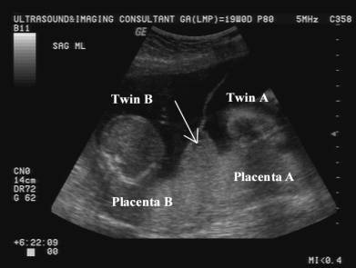 Twin Peak Sign (Lambda sign) = Dichorionic Pregnancy