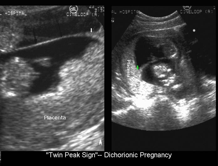 Signs of twin pregnancy
