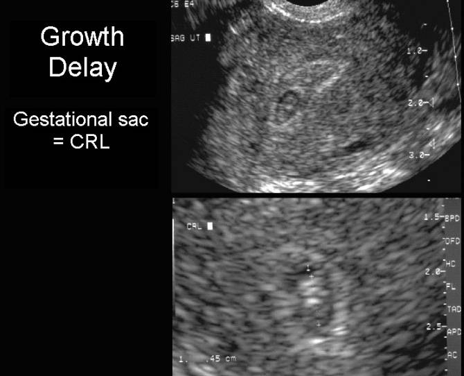 Gestational Sac Growth Chart