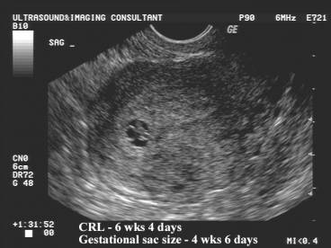 Gestational Sac Size Chart