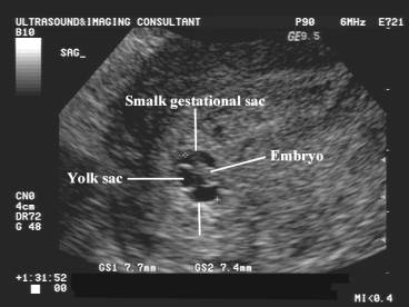 Gestational Sac Mean Size Chart