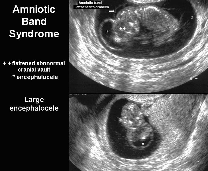 Amniotic Band Syndrome