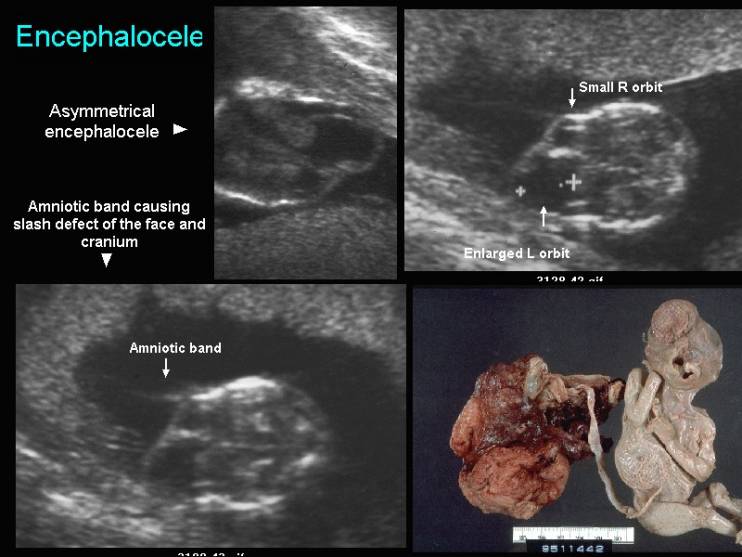 The amniotic band syndrome is a group of sporadic congenital anomalies 