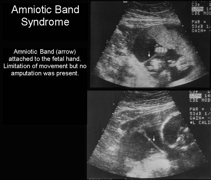 Amniotic Band Syndrome Ultrasound