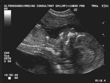 Screening nuchal translucency what is Nuchal translucency