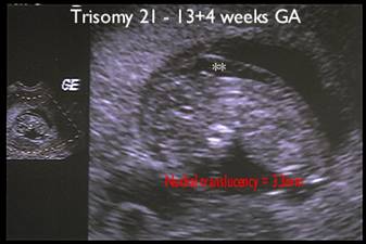 Ultrasound nuchal thickness Nuchal translucency