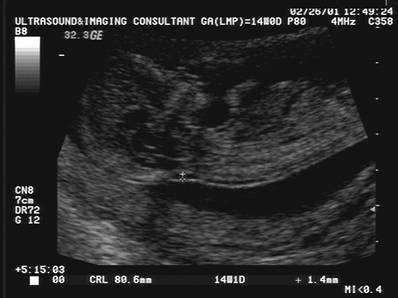 Nuchal Translucency Range Chart