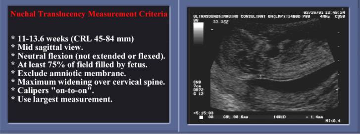 Nuchal Translucency Range Chart