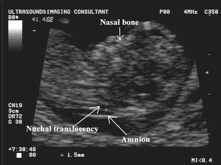 Nuchal Fold Measurement Chart