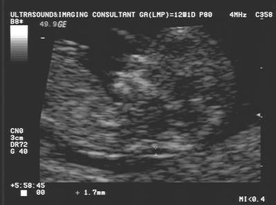 Nuchal Translucency Measurement Chart