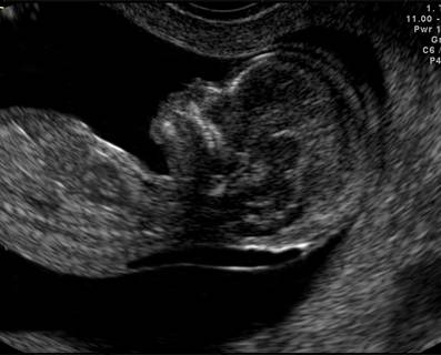 Nuchal Fold Measurement Chart