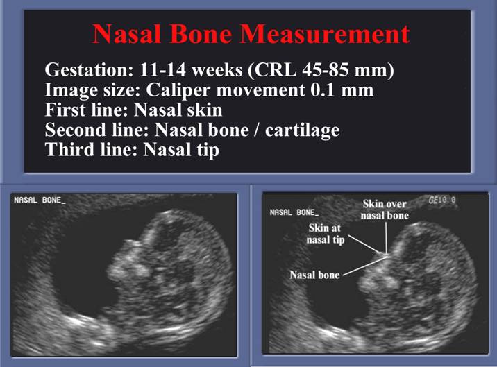 Fetal Nasal Bone Length Chart