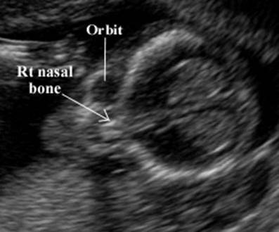 Fetal Nasal Bone Length Chart