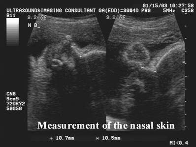 Fetal Nasal Bone Length Chart