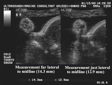 Fetal Nasal Bone Length Chart