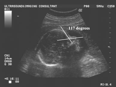 Fetal Nasal Bone Length Chart