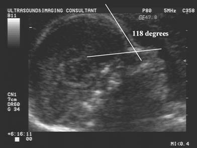 Fetal Nasal Bone Length Chart