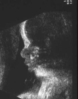 Fetal Nasal Bone Length Chart