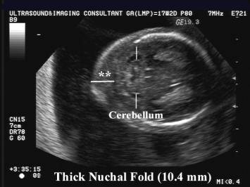 Ultrasound nuchal thickness Nuchal Translucency