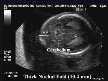 Fold what is a nuchal Nuchal cord