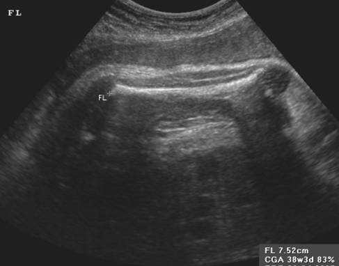 Femur Length Ultrasound Chart