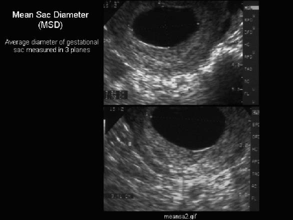 Gestational Sac Size Chart