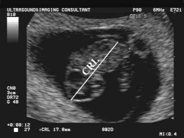 Fetal Biometry Crl Chart