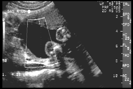 Pregnancy Sonography Chart