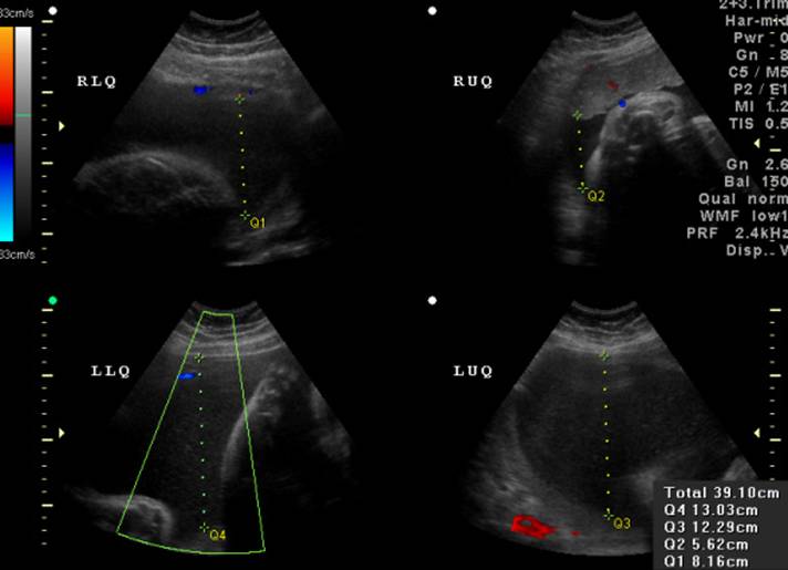 Normal Amniotic Fluid Index Chart In Cm