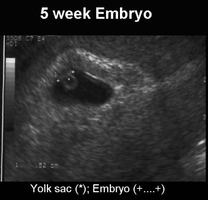 Week 5 Of Gestation