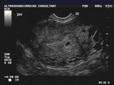 Ultrasound 4 weeks 4 days
