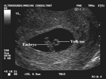 Weeks 7 crl at Small embryo