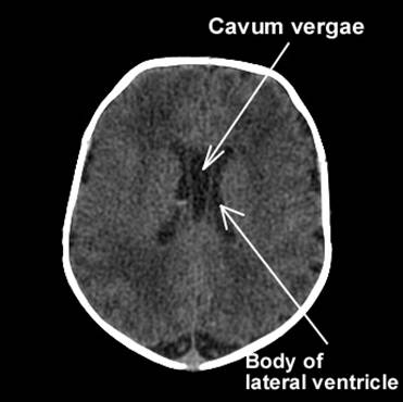 Image result for CAVUM VERGAE
