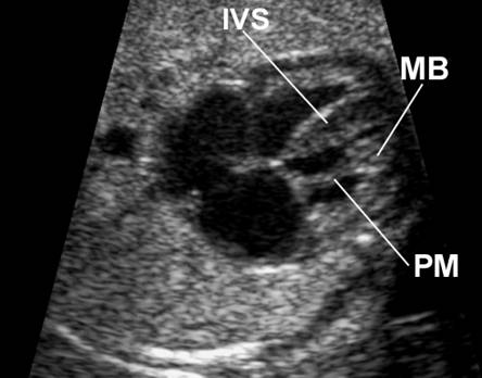 ECHO picture with hyperechoic moderator band in the right ventricle