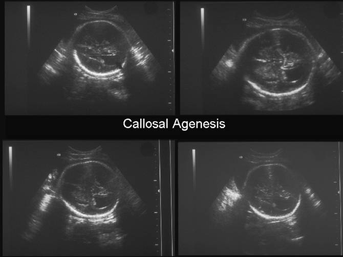 Ultrasound Of Callosal Agenesis Ultrasound Of Callosal Agenesis