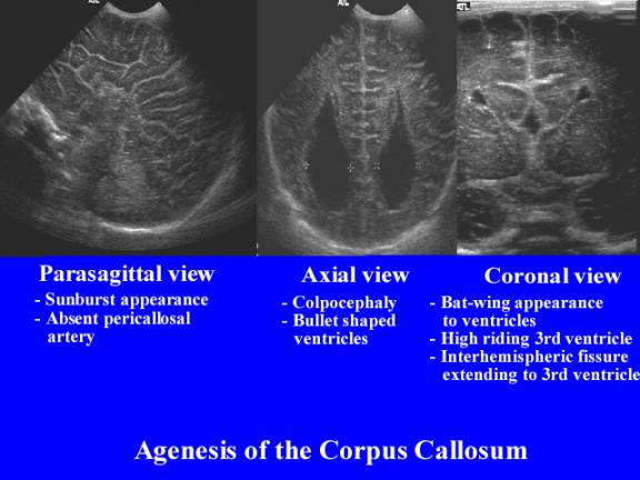 Ultrasound Of Callosal Agenesis Ultrasound Of Callosal Agenesis
