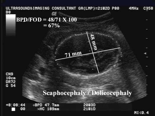 Brachycephaly Cephalic Index Chart