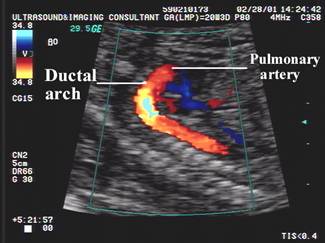 Ductal Arch
