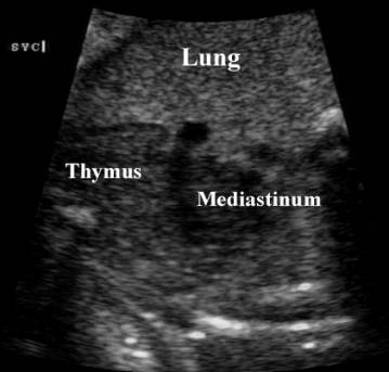 thymus gland fetal