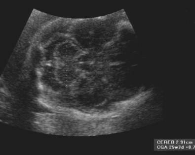 Fetal Cerebellum Measurement Chart