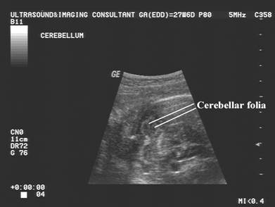 Fetal Cerebellum Measurement Chart