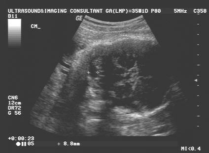 Fetal Cerebellum Measurement Chart