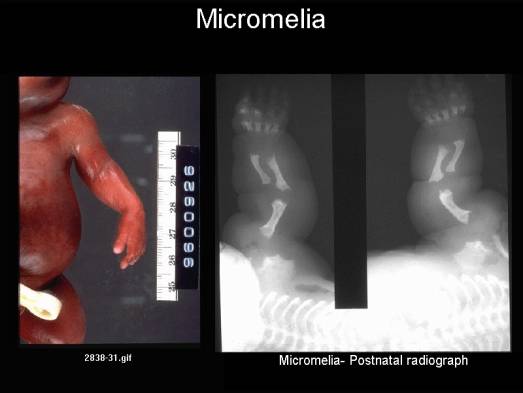 Micromelia