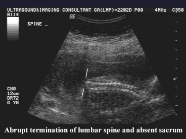 sirenomelia ultrasound