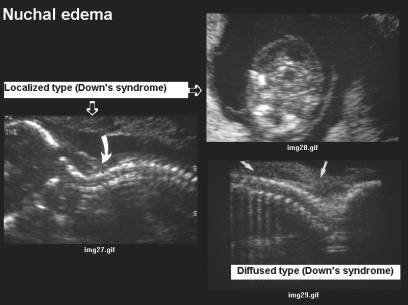 down syndrome sonogram