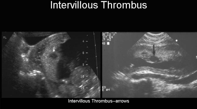 Intervillous Thrombosis