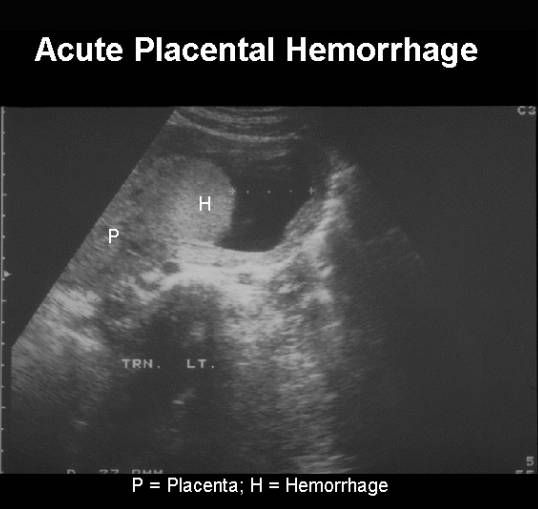 Image result for placenta hematoma ultrasound