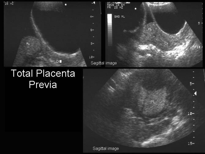 Classification of Placenta Previa